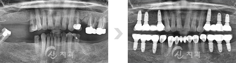 임플란트1.jpg