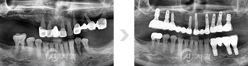 임플란트2.jpg
