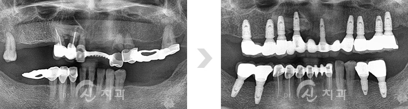 임플란트3.jpg
