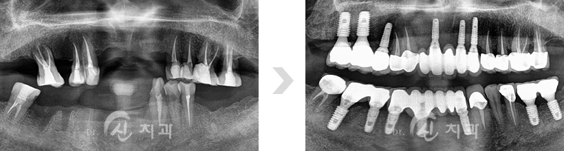 임플란트4.jpg